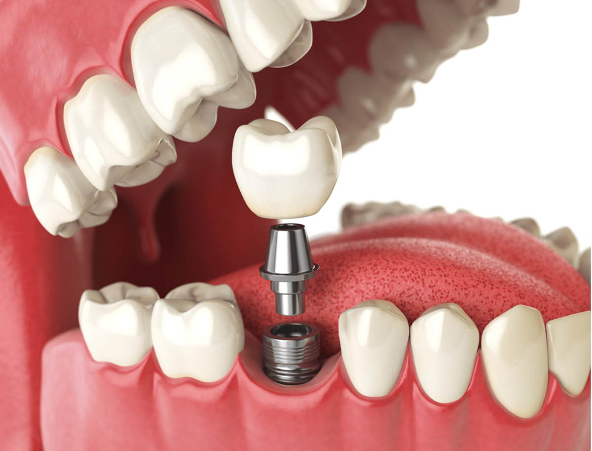 Advanced implant dentistry and structural restoration